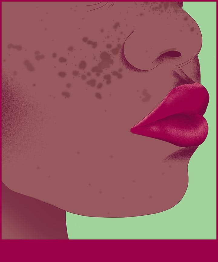 An illustration of a woman's face with hyperpigmentation (dark spots)
