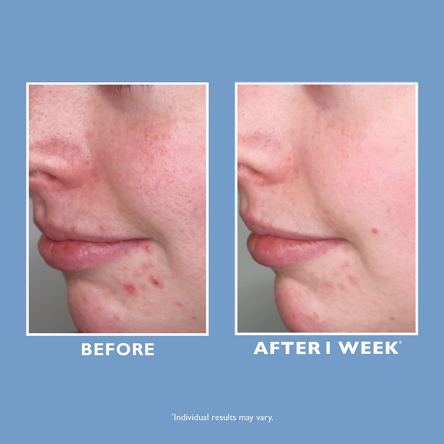 peter thomas roth exfoliating clarifying liquid