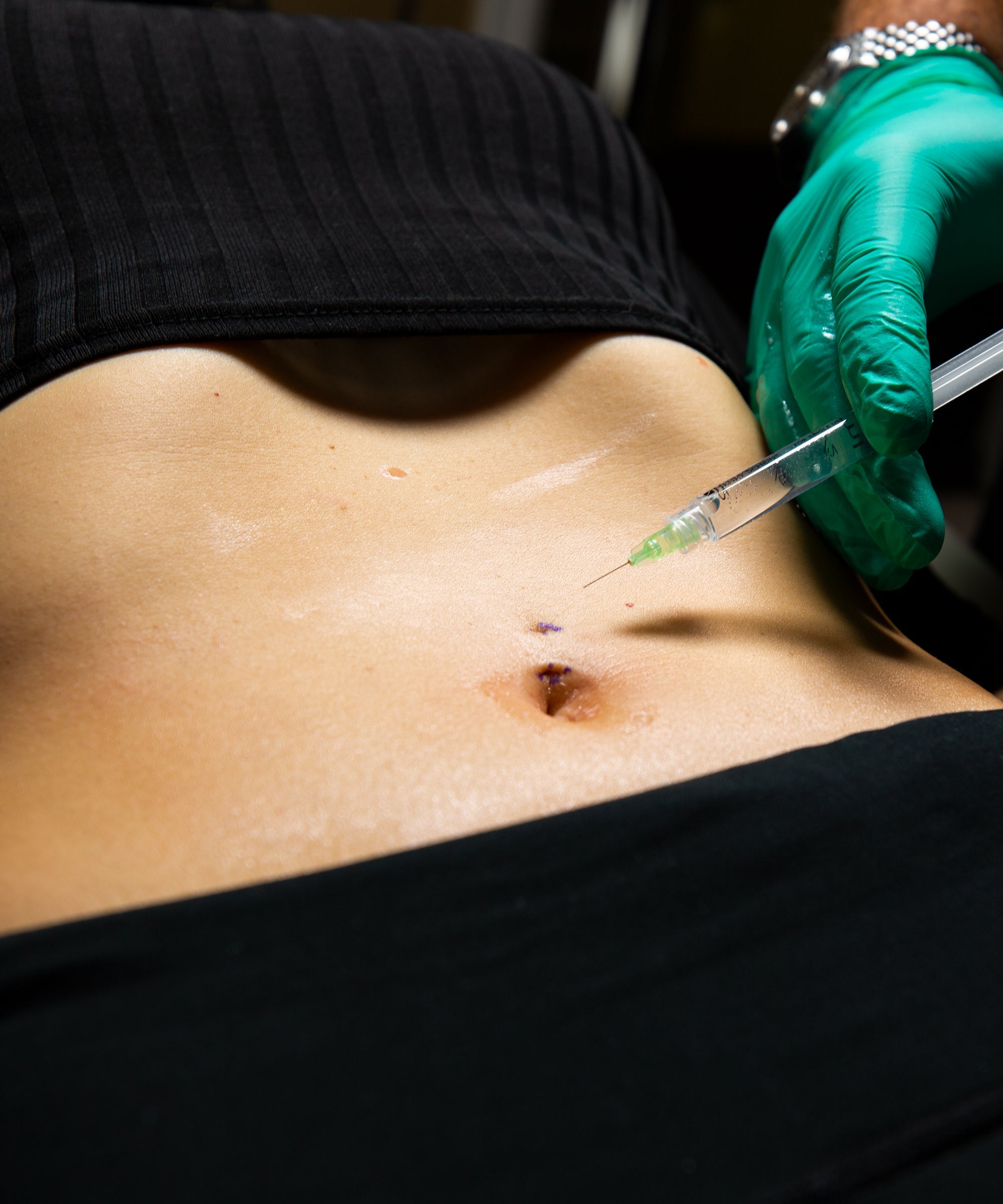 Vidéo chirurgie d'ablation d'un piercing au nombril