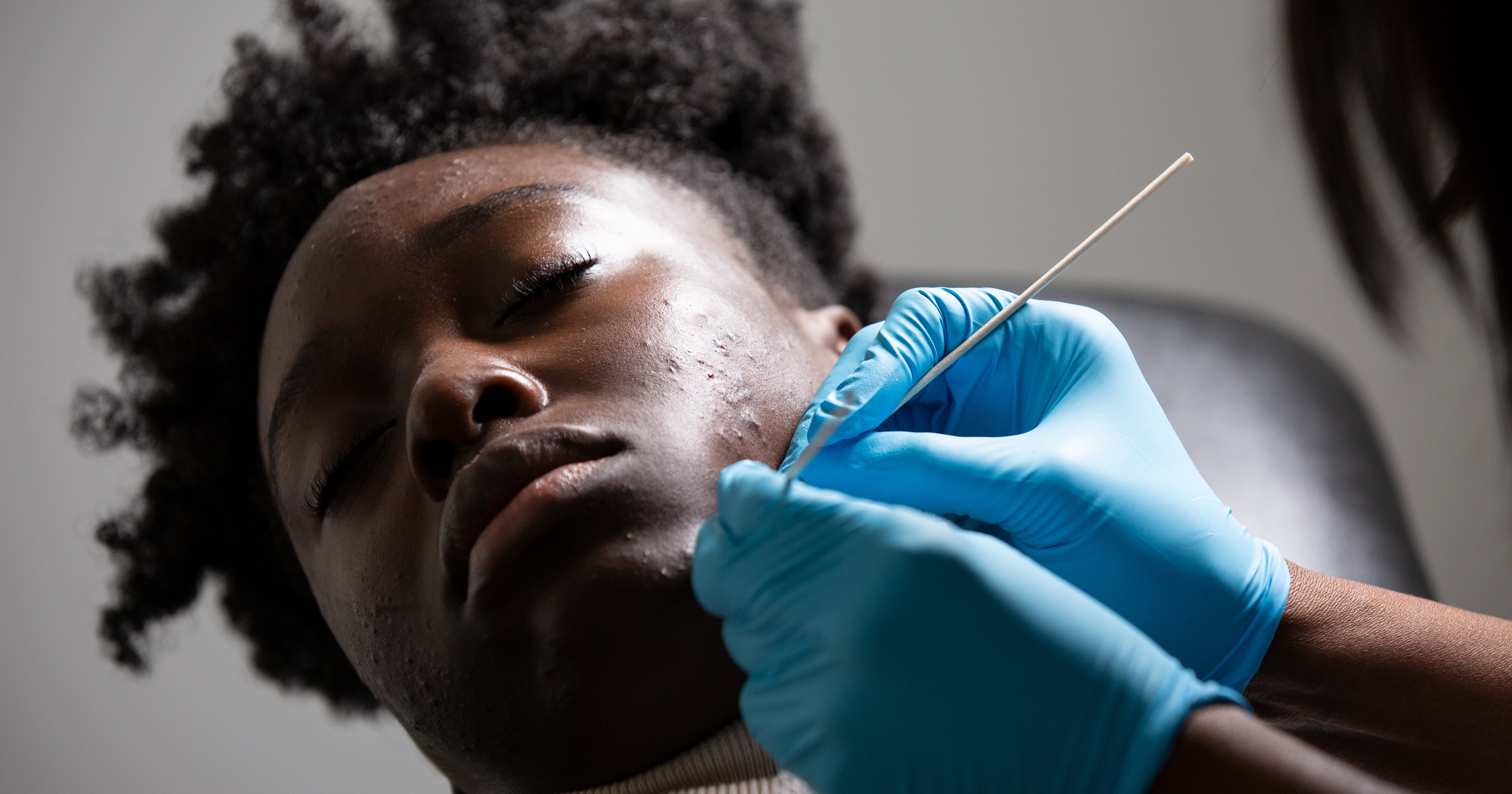 The World's Largest Blackhead? You Be The Judge!