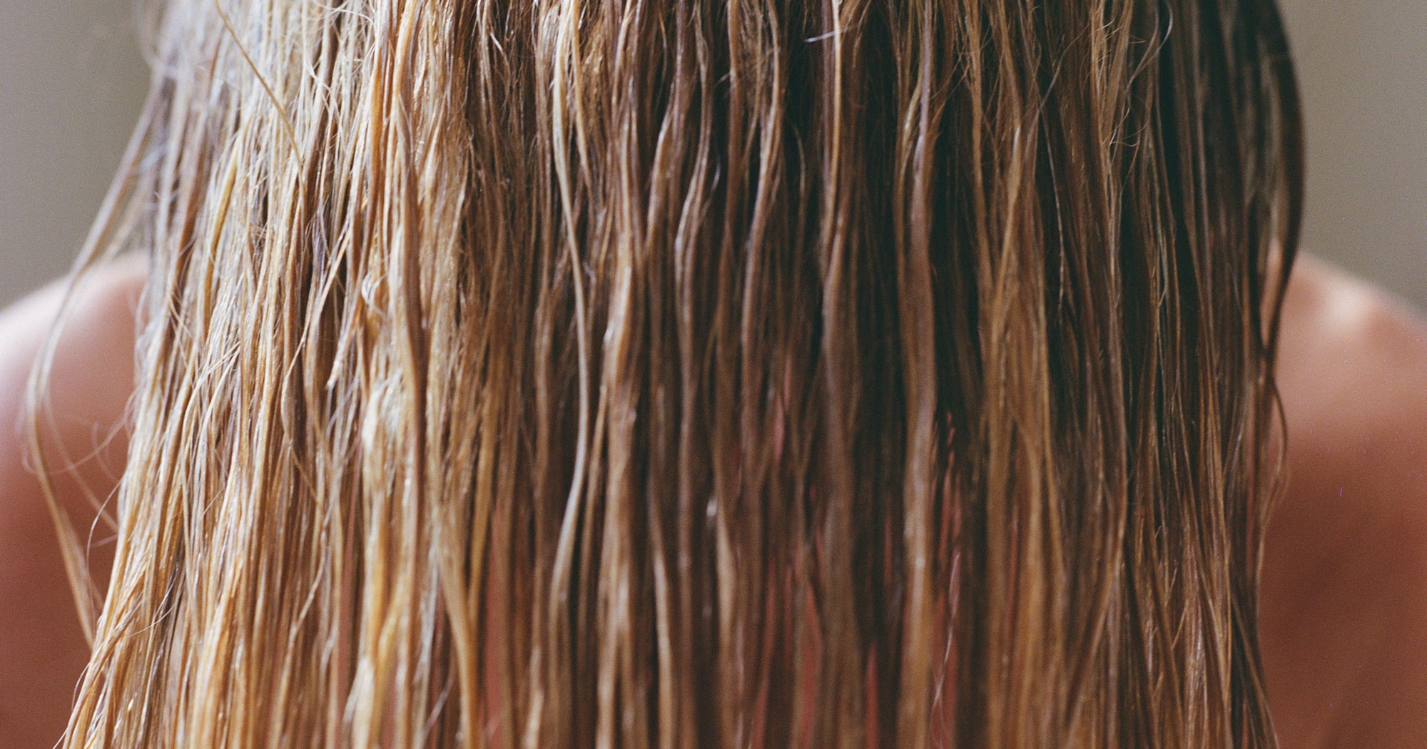 Receding Hairline In Women: Causes & Helpful Treatments