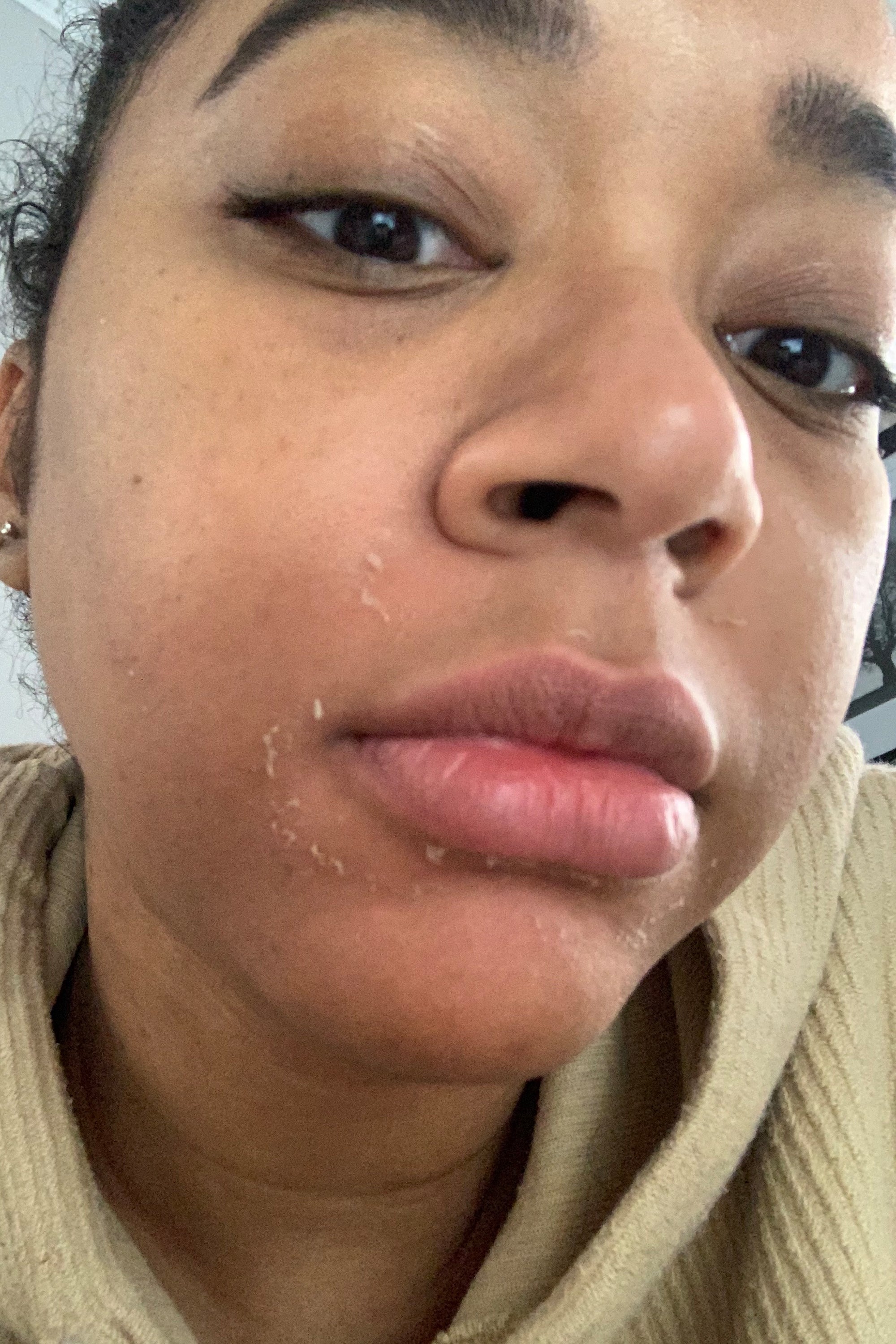 Why is My Skin Peeling on My Face After Skincare