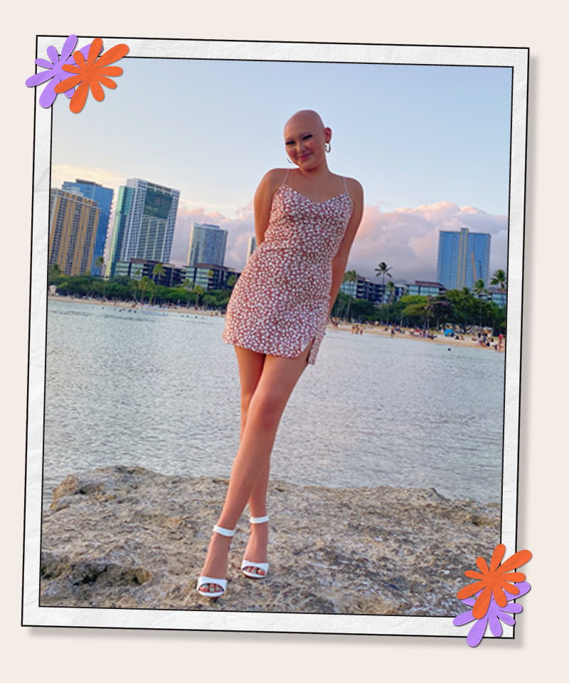 I’m Redefining Beauty By Embracing My Baldness On Social Media 9 10533893