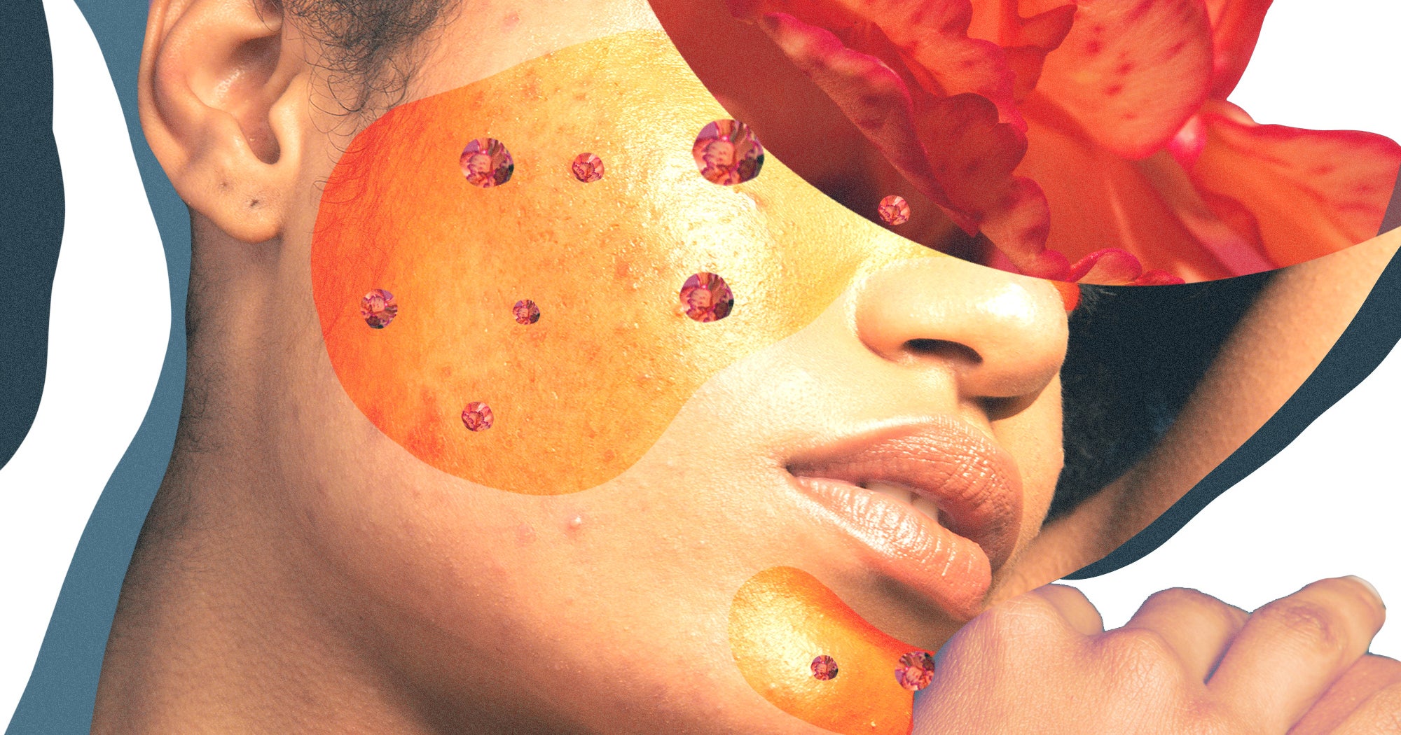 How To Treat Hormonal Hyperpigmentation