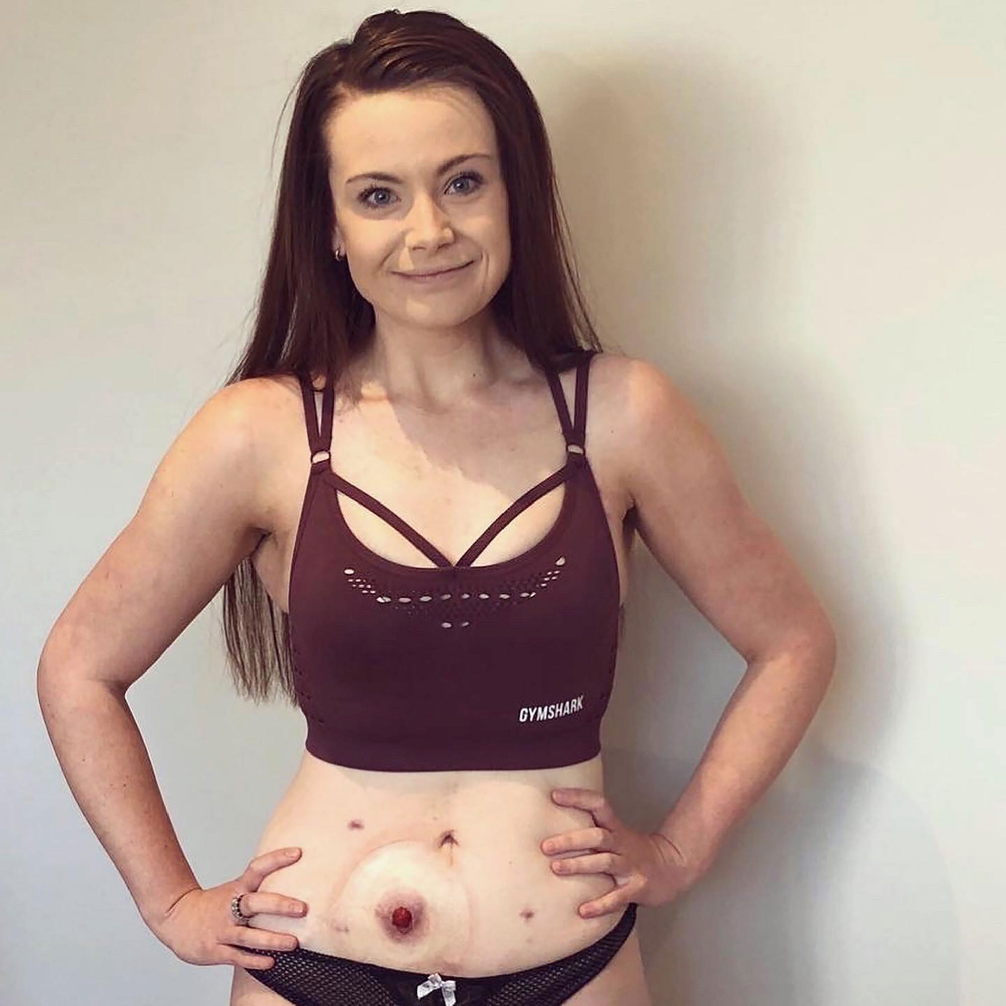 My Survival Story - Living With An Ileostomy Bag 