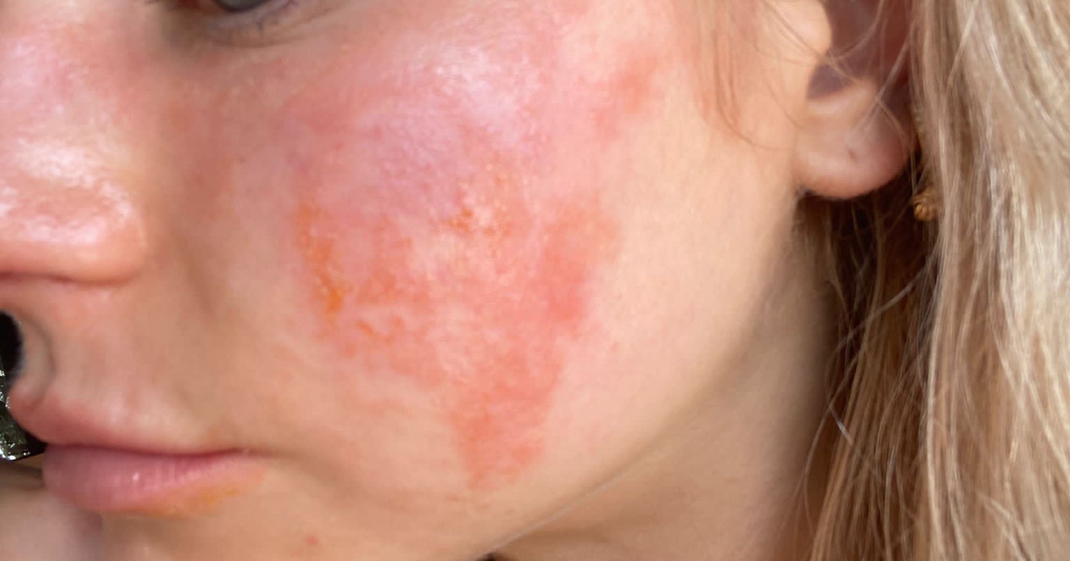 Gluten Rash Face gluten-rash-face