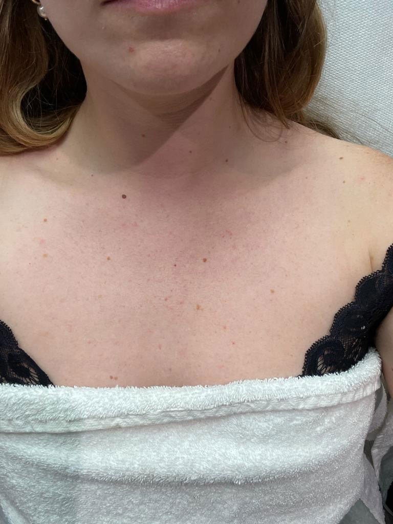 I Got My Chest Lasered To Improve My Skin & I Learned A Lot