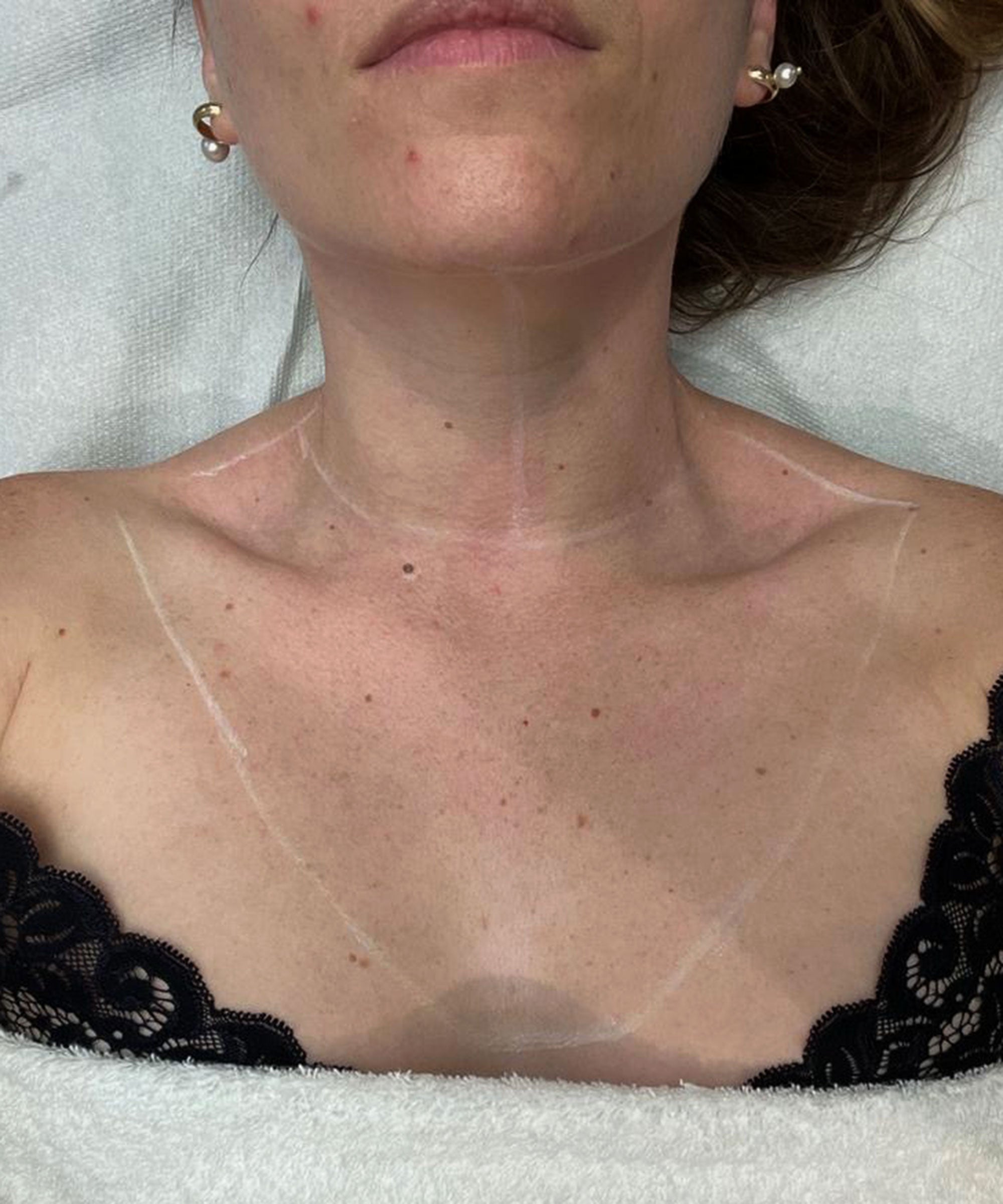 Experts Reveal the Neck-Sculpting Treatments That Most Patients Don't Know  About - NewBeauty