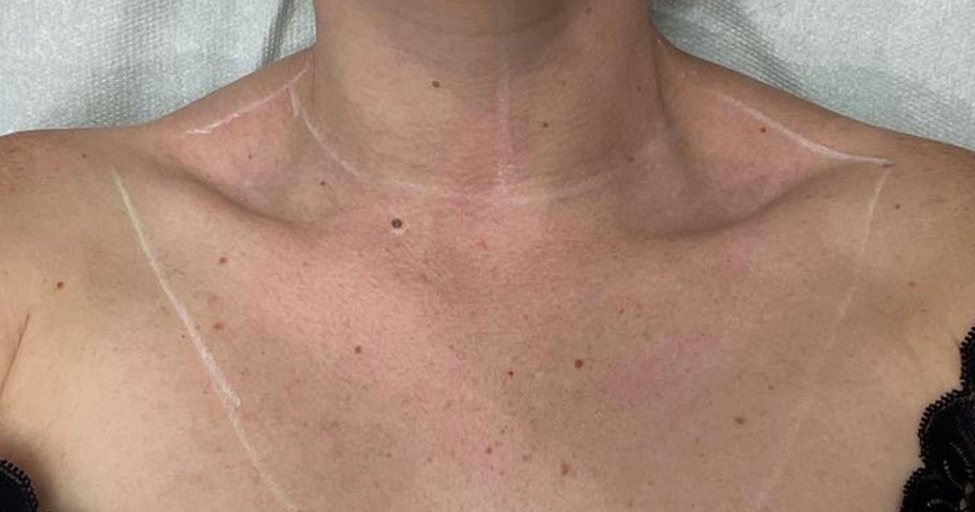 I Got My Chest Lasered To Combat Sun Damage & I Learned A Lot I Got My Chest Lasered To Combat Sun Damage & I Learned A Lot