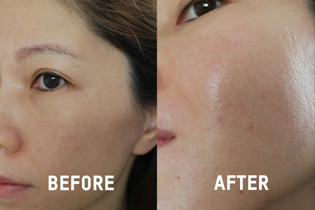 Hyaluronic Acid Serum Is Producing Amazing Before and After Photos