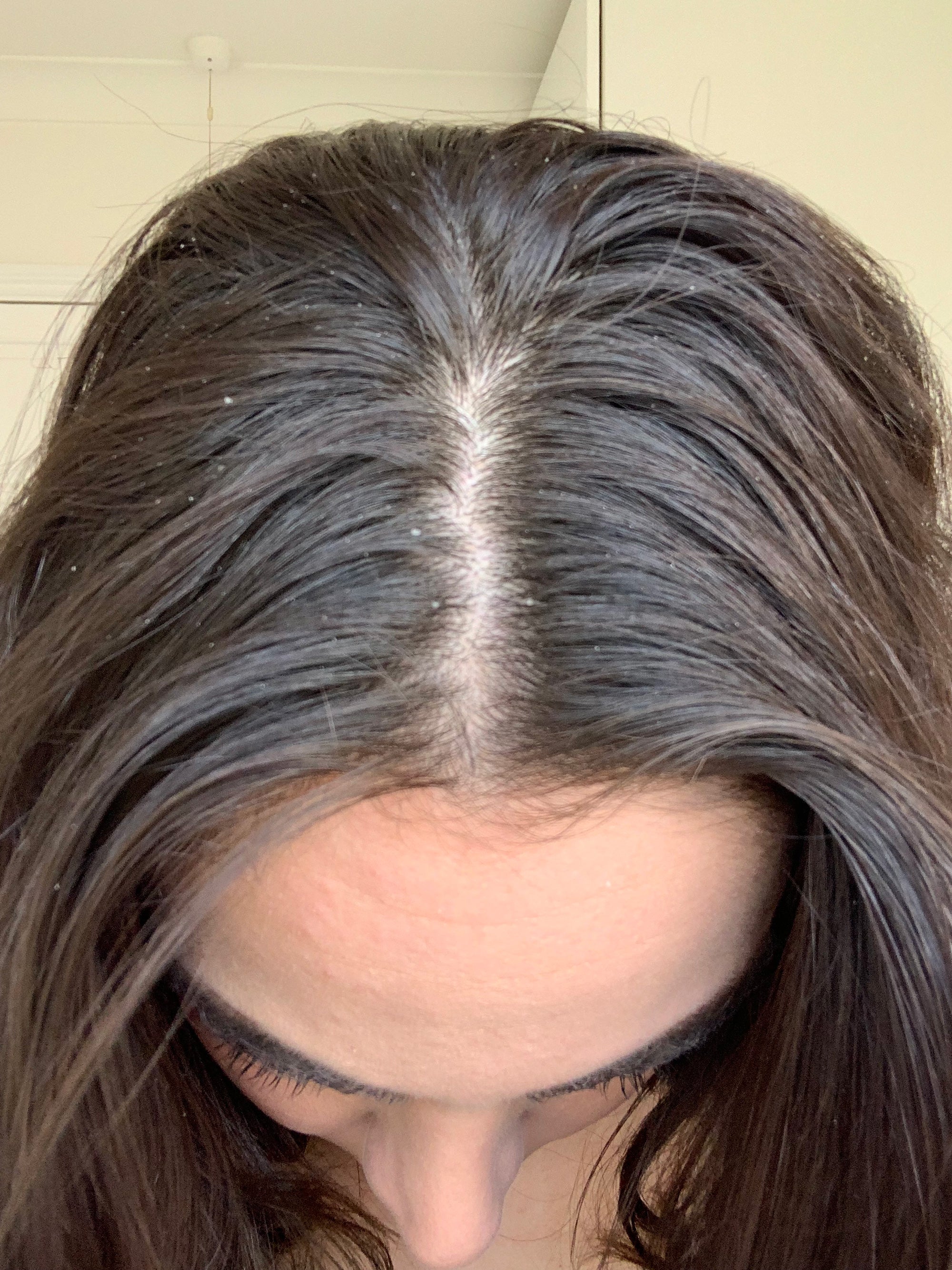 I Tried TikTok's Glycolic Acid Dandruff Hack & It Works