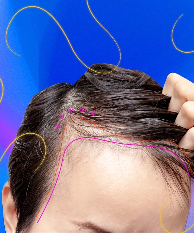 The Real Reason Why Men Are So Secretive About Hair Transplants