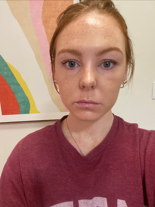 allergic-reaction-on-face