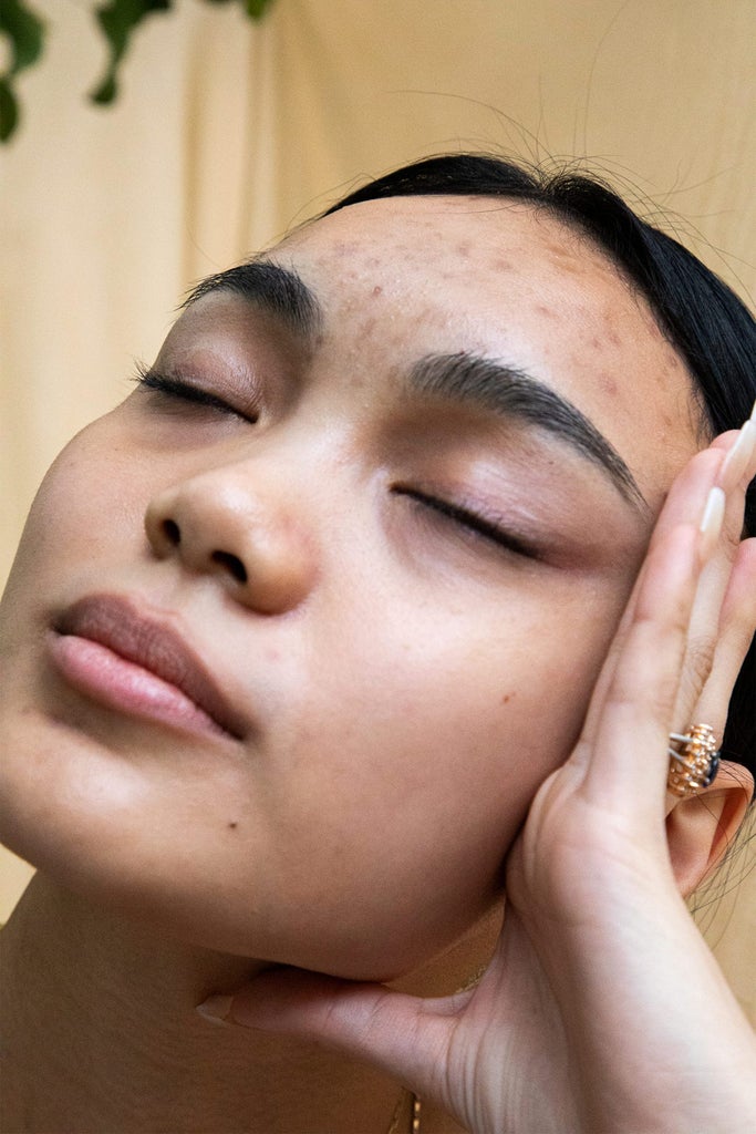 In Case You Need To Hear It: Acne Doesn’t Make You Look Unprofessional