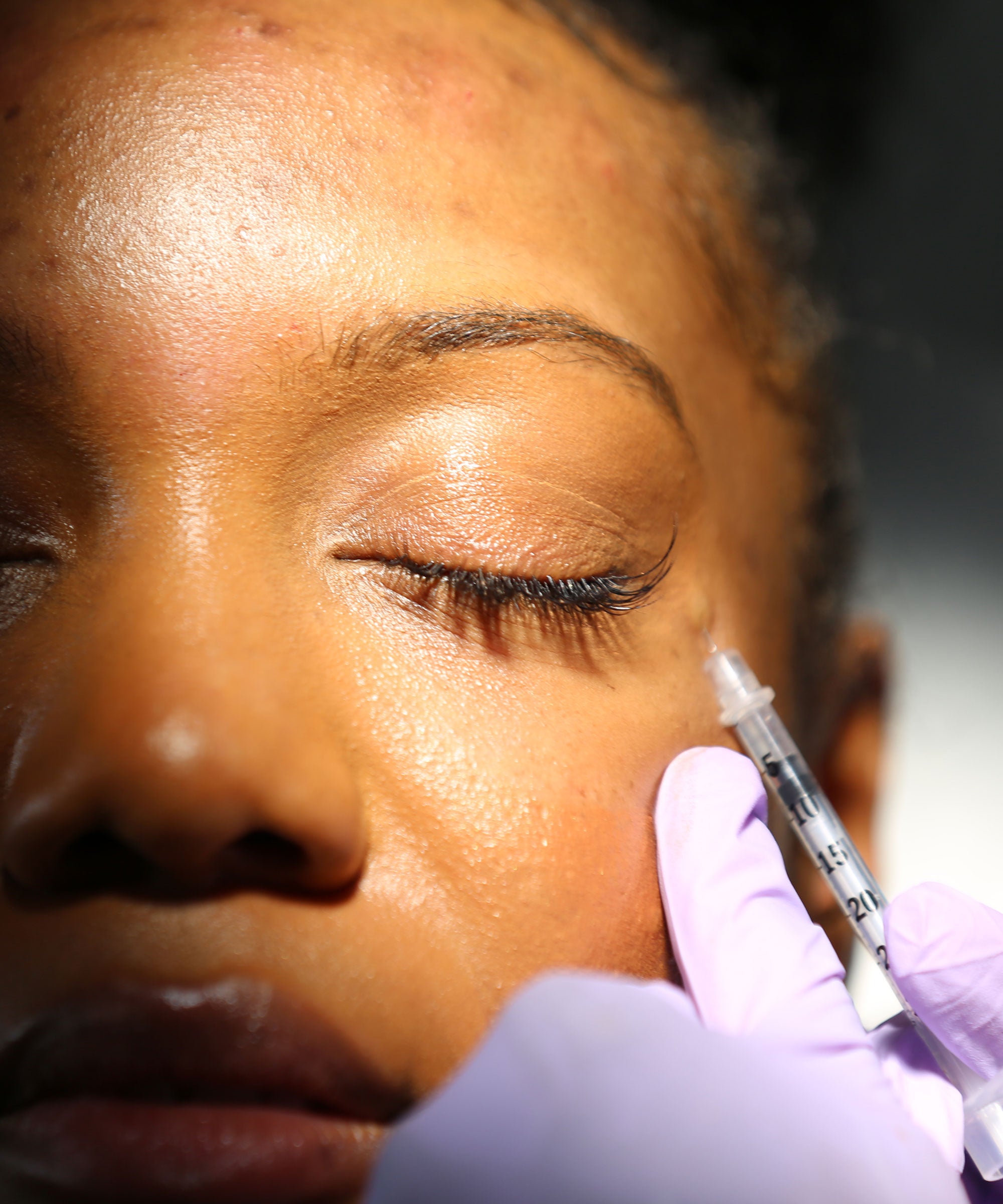 I'm A Black Woman Here's How My First Botox Trip Went