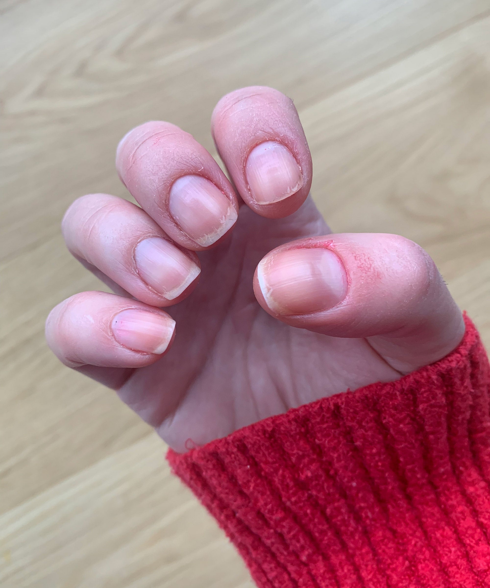 How to Stop Biting Nails and Cuticles — Expert Advice | Allure