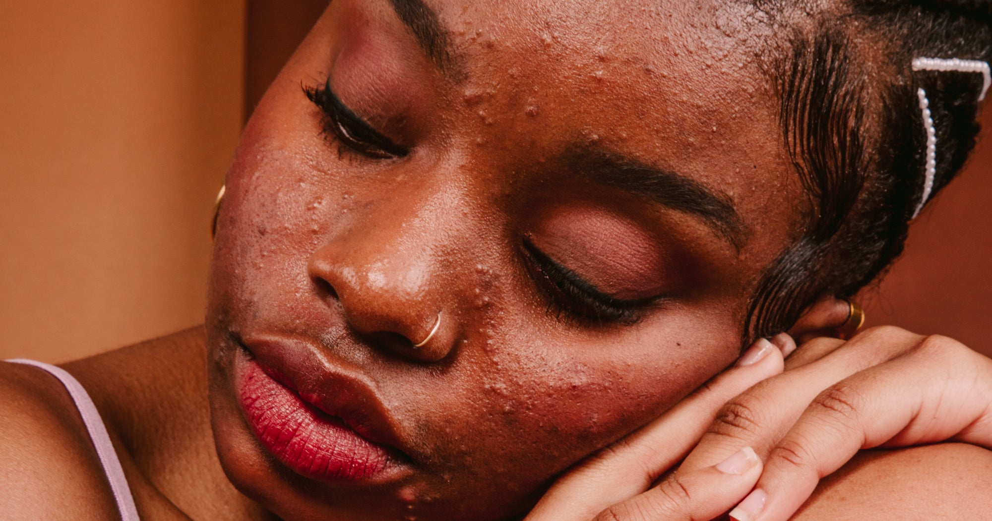 A Dermatologist Just Set Me Straight On These 9 Acne Myths