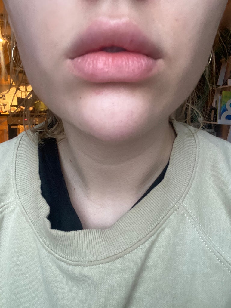 I Tried “Injectable Lip Balm” For My Chronically Dry Lips & I Have Thoughts