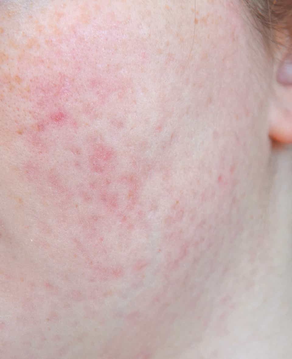 How To Fade Pitted Acne Scars Best - How To Cover Ice Pick Scars With Makeup How To Fade Pitted Acne Scars Best - How To Cover Ice Pick Scars With Makeup