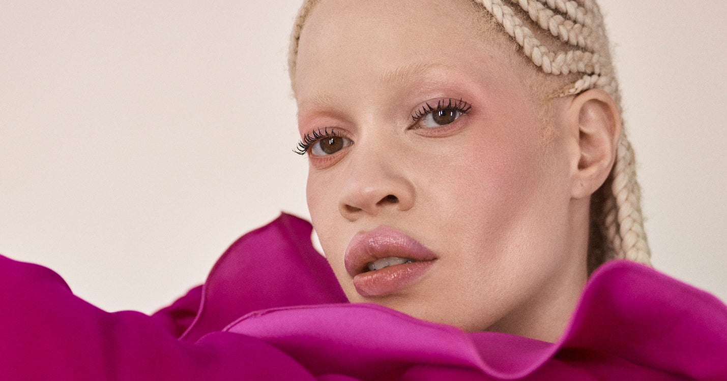 I Was Bullied For My Albinism — Now It’s My Biggest Source Of Confidence