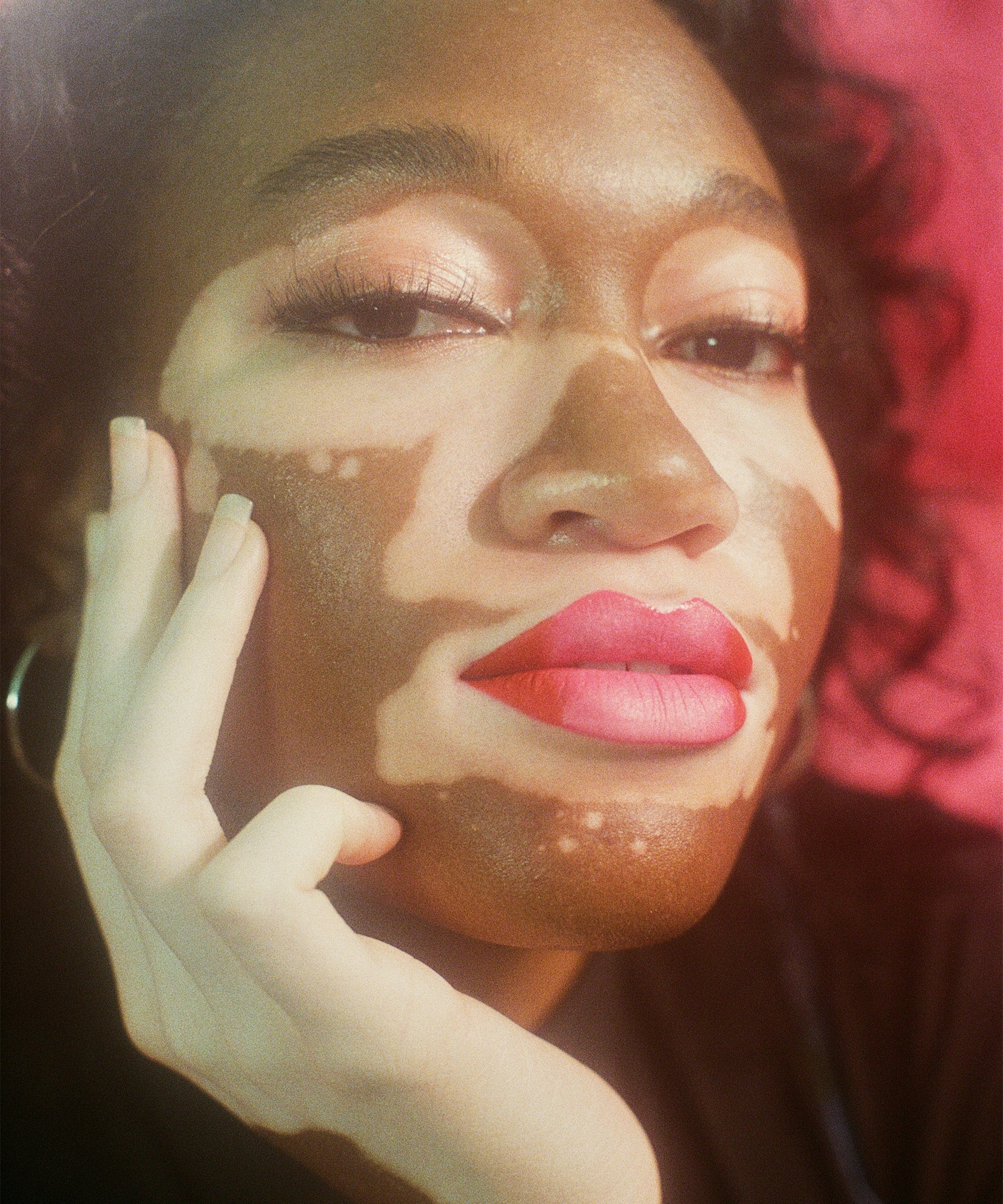 Dating någon med vitiligo