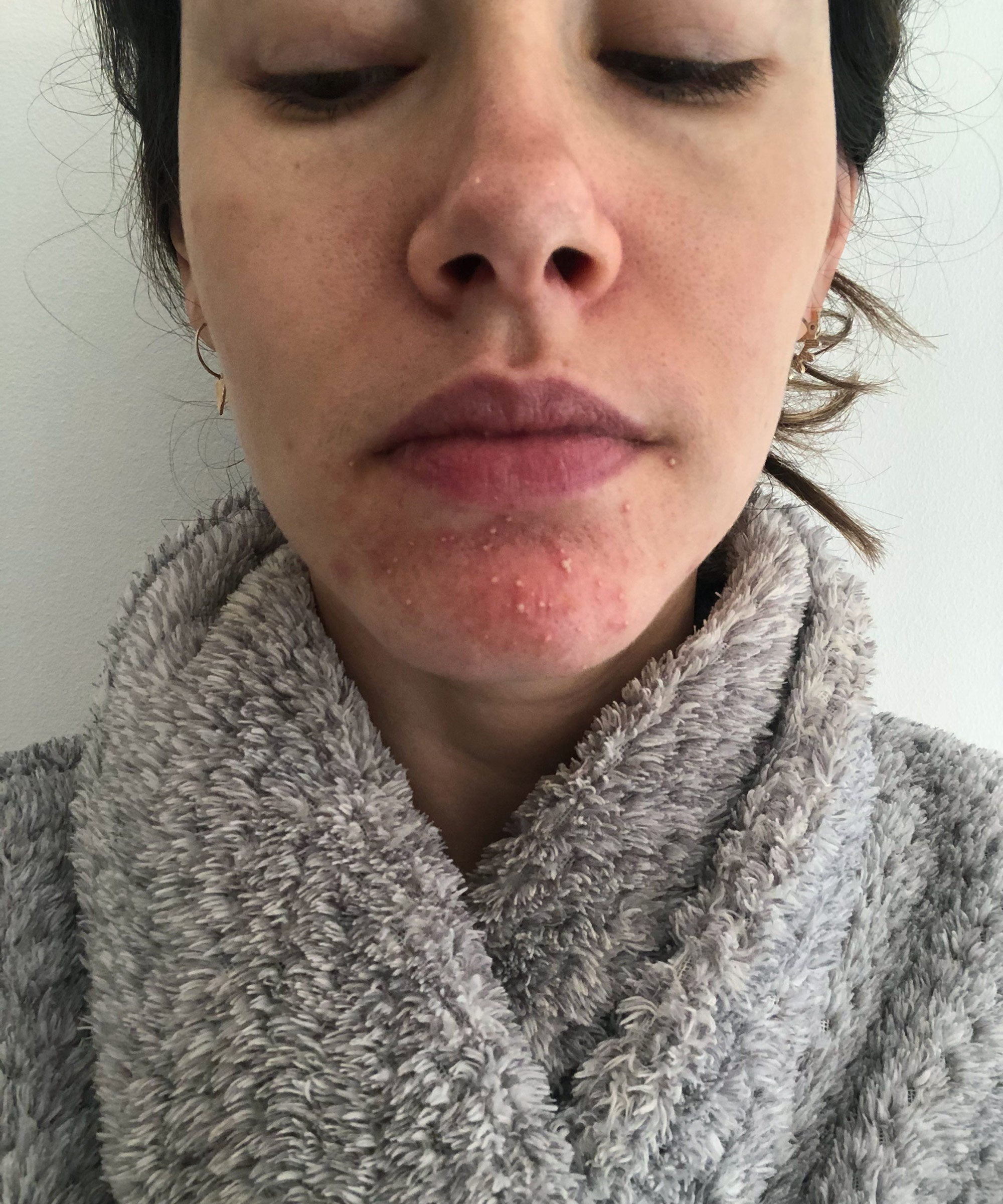 Rosacea Symptoms, Diagnosis, & Treatment: Expert Tips