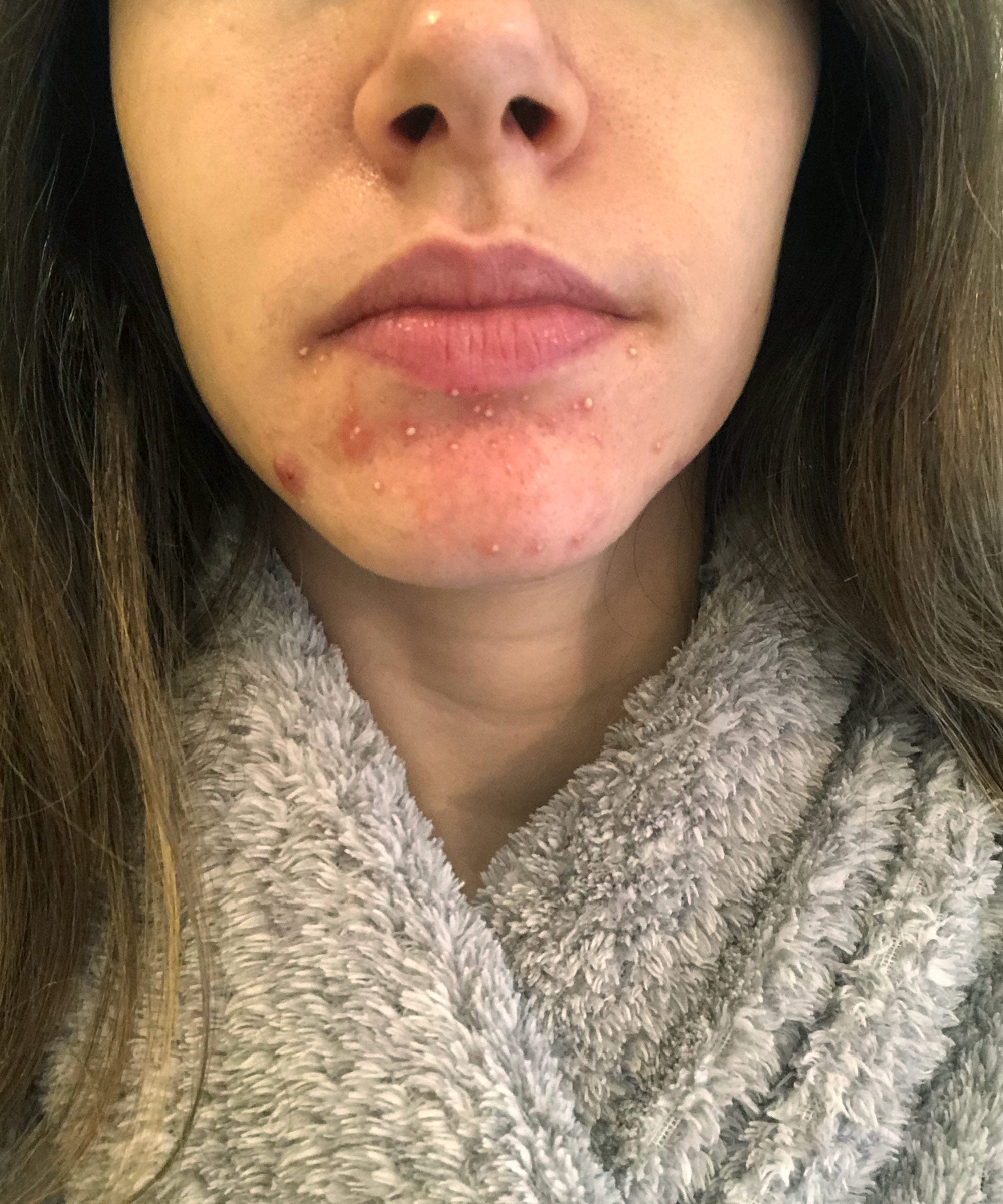 Rosacea Symptoms, Diagnosis, & Treatment: Expert Tips