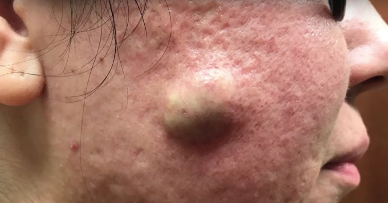 Dr Pimple Popper Drains A Huge Cyst Reverasite