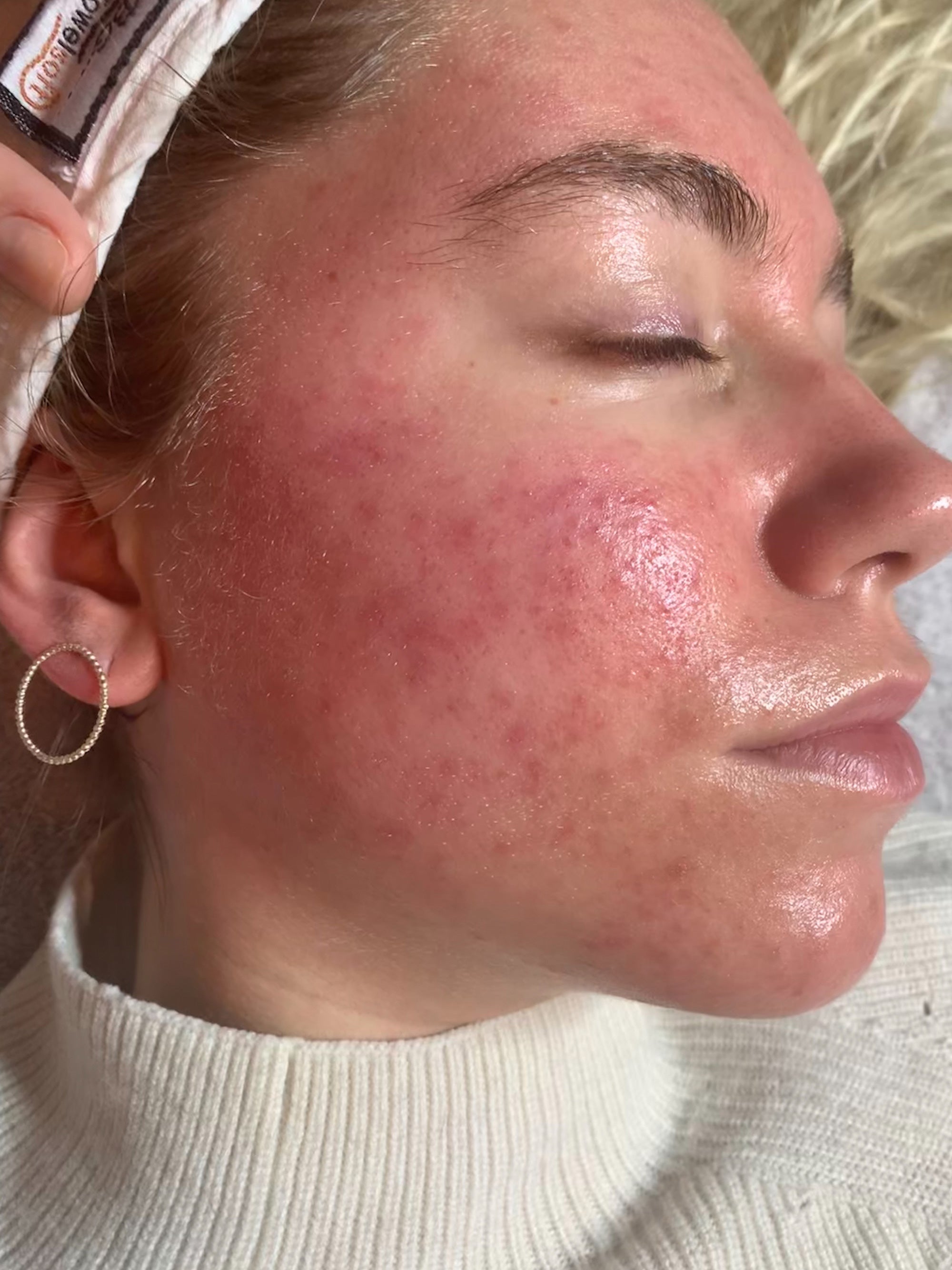 Why is My Skin Darker After Microneedling?  