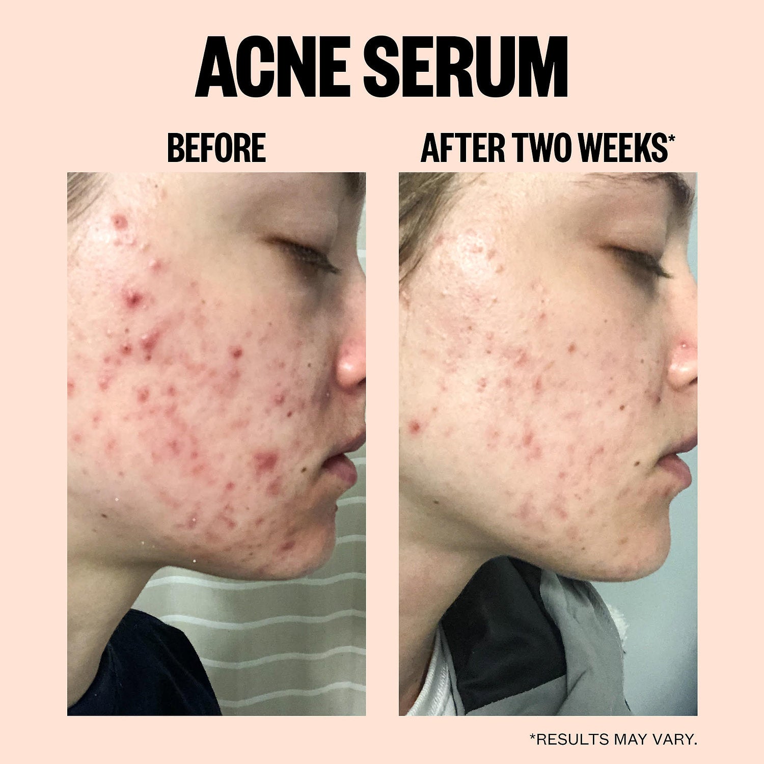 peace out acne serum