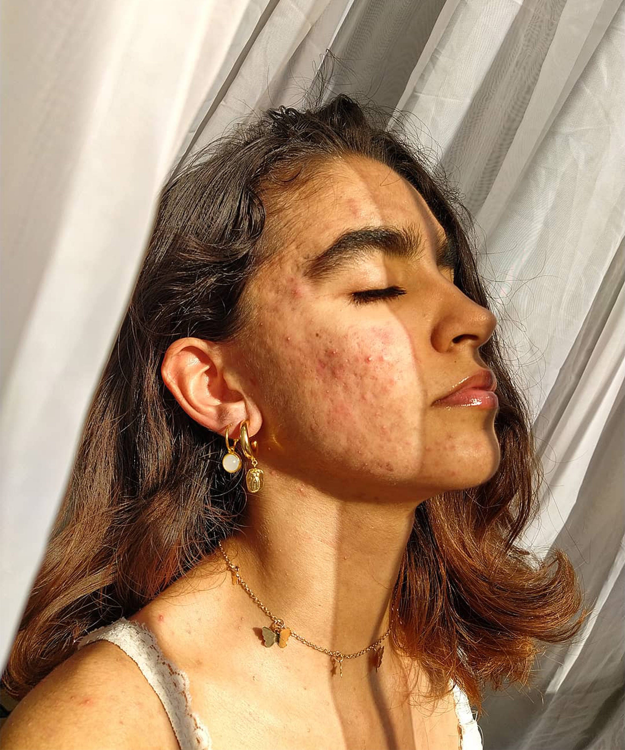 Nebenwirkungen Ruckfalle Akzeptanz 4 Frauen Teilen Ihre Erfahrungen Dem Aknemittel Isotretinoin Prettify Today