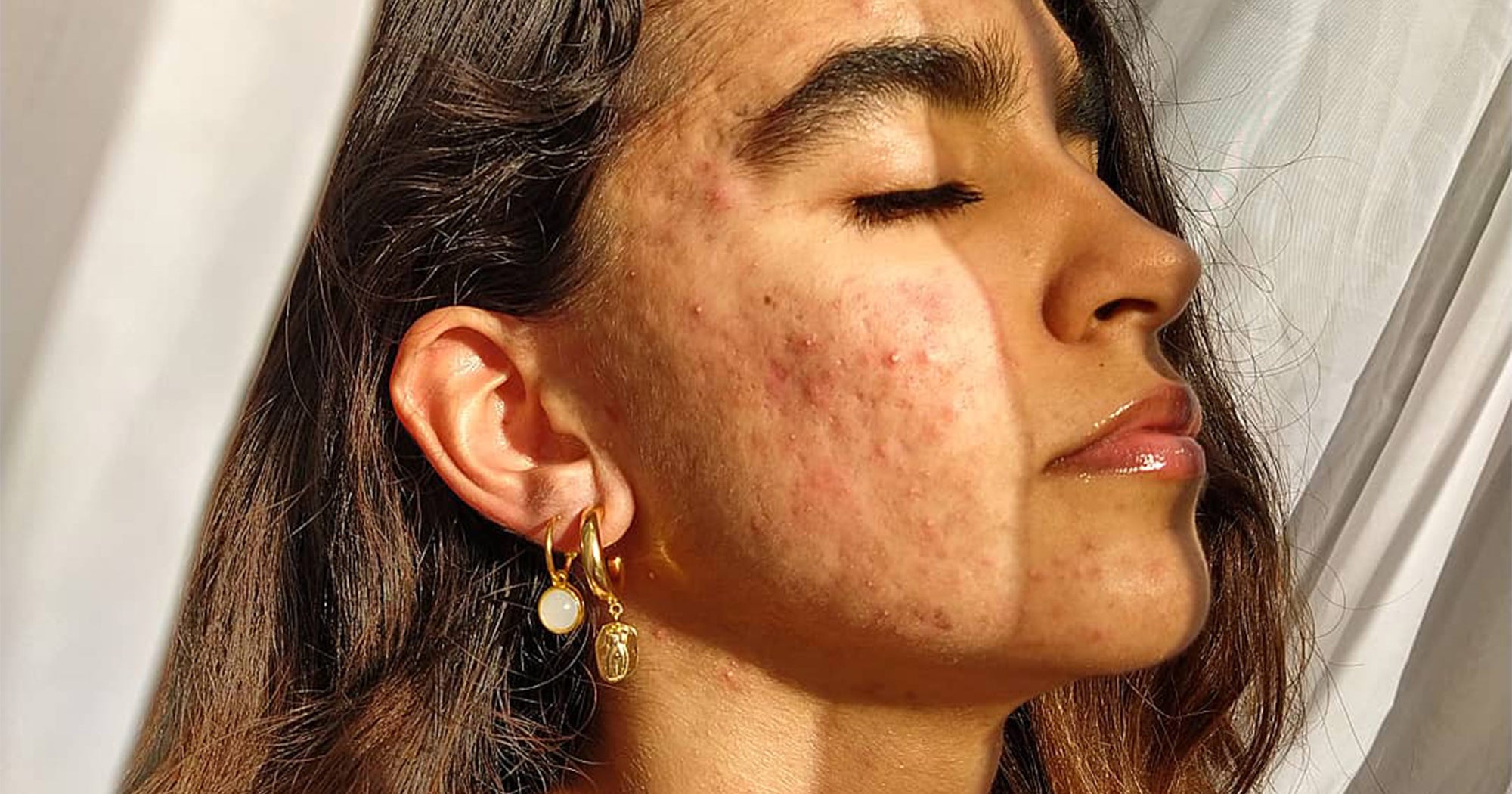 Roaccutane et l'acné : les possibles effets secondaires