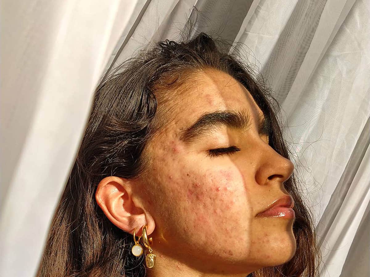 Akne 4 Frauen Teilen Ihre Erfahrungen Mit Isotretinoin Akne 4 Frauen Teilen Ihre Erfahrungen Mit Isotretinoin