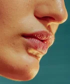 Que faire en cas de coup de soleil sur les lèvres ?
